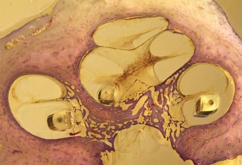Hear better when you preserve remaining hearing with cochlear implantation